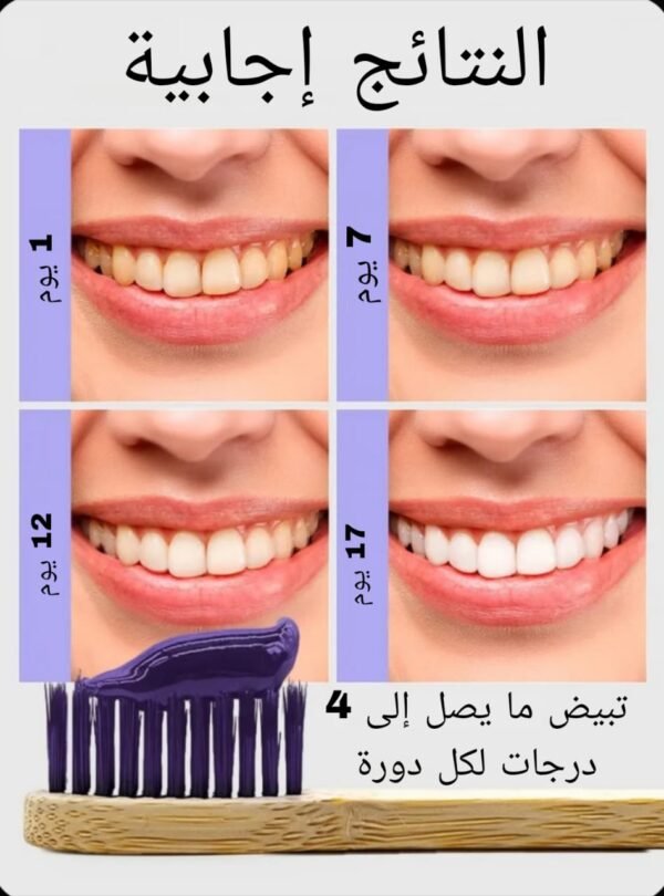 Blancheur Dentaire Premium – Gel de Blanchiment des Dents (30ml)